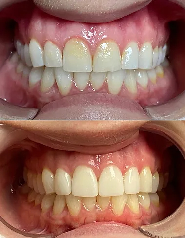 Smile before and after ceramic dental crowns and laser gingivoplasty