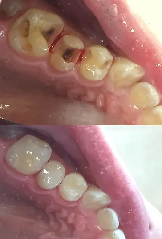 Smile before and after white dental fillings