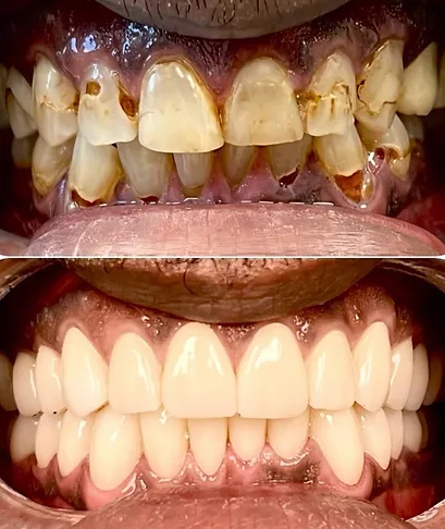 Smile before and after periodontal therapy and ceramic crowns
