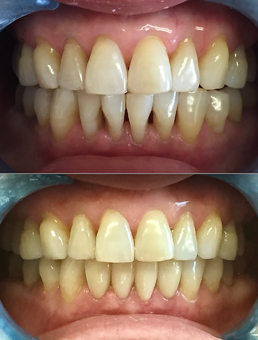 Smile before and after treatment with ceramic dental crowns and laser gingivoplasty