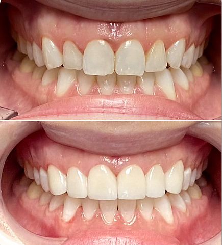 Smile before and after getting four ceramic dental crowns