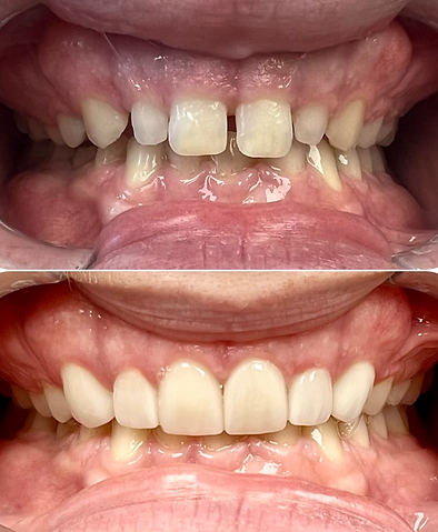 Smile before and after getting six dental crowns and laser gingivoplasty