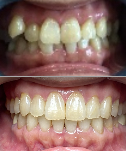 Smile before and after teeth whitening and Invisalign treatment