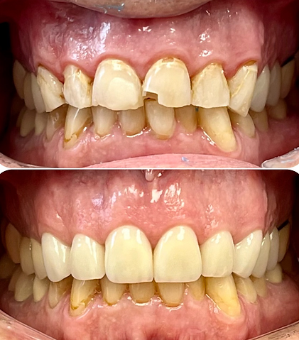 Smile before and after fixing broken teeth with dental crowns